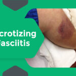 What is the Most Common Cause of Necrotizing Fasciitis?
